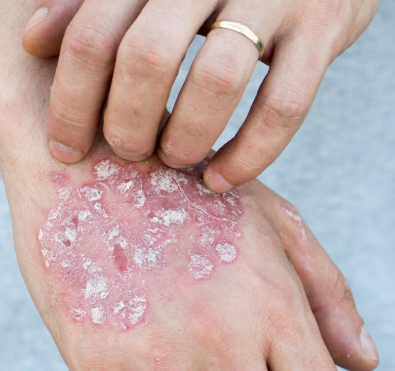 Psoriasis